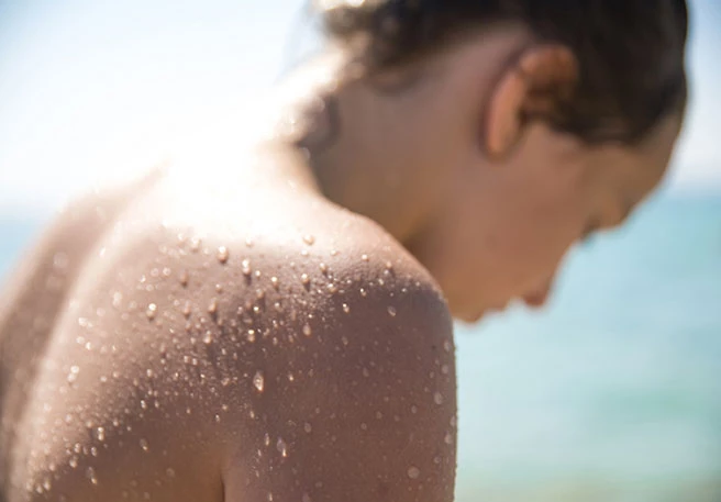 Frau am Strand Mallorca-Akne bei jungen Frauen