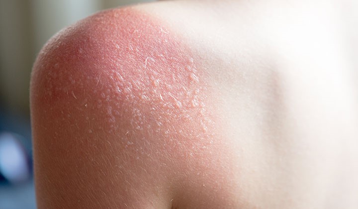 Schwerer Sonnenbrand Blasen Auf Der Haut Behandeln Ladival